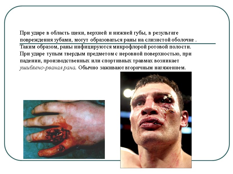 При ударе в область щеки, верхней и нижней губы, в результате  повреждения зубами,